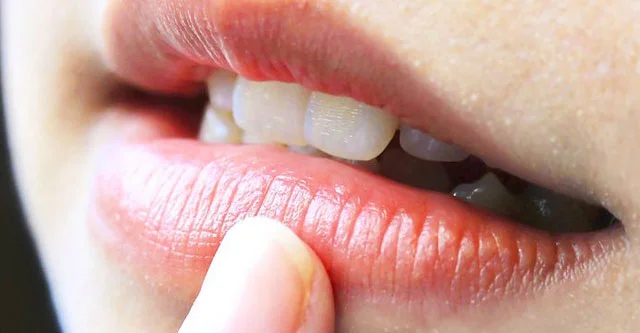 Easy tips to prevent or get rid of Dry Lips