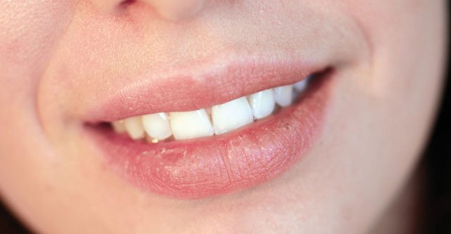 Can Diabetes Cause Dry Lips? 9 Easy Tips for Prevention