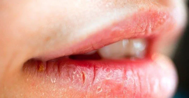 What are the effects of drying lips due to diabetes